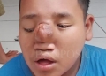 Salah seorang anak warga Desa Gunung Wangun Kecamatan Cibeber yang mengalami derita benjolan di hidung.
