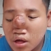 Salah seorang anak warga Desa Gunung Wangun Kecamatan Cibeber yang mengalami derita benjolan di hidung.